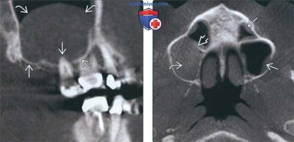 Лучевая диагностика муцинозной ретенционной псевдокисты околоносовой пазухи