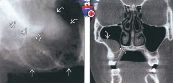 Лучевая диагностика муцинозной ретенционной псевдокисты околоносовой пазухи