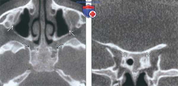 КТ при гипоплазии и аплазии околоносовой пазухи