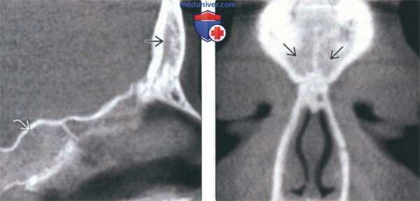 КТ при гипоплазии и аплазии околоносовой пазухи