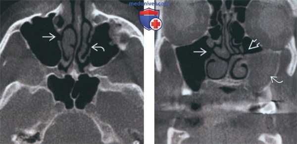 Лучевая диагностика добавочного устья верхнечелюстной пазухи