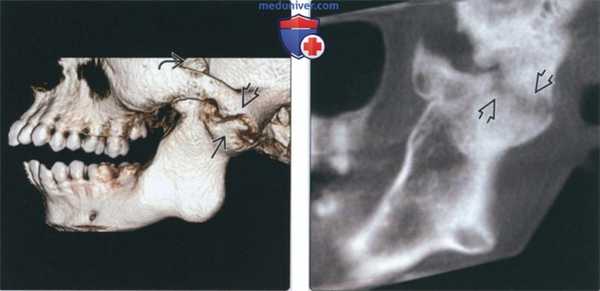 Лучевая диагностика фиброзного анкилоза височно-нижнечелюстного сустава (ВНЧС)