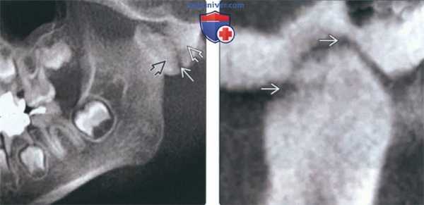 Лучевая диагностика фиброзного анкилоза височно-нижнечелюстного сустава (ВНЧС)