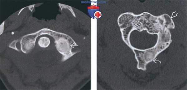 Лучевая диагностика фиброзной дисплазии шейных позвонков
