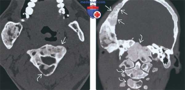 Лучевая диагностика фиброзной дисплазии шейных позвонков