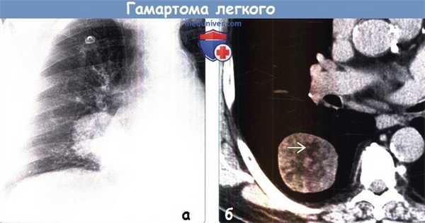 Гамартома легкого на рентгенограмме и КТ