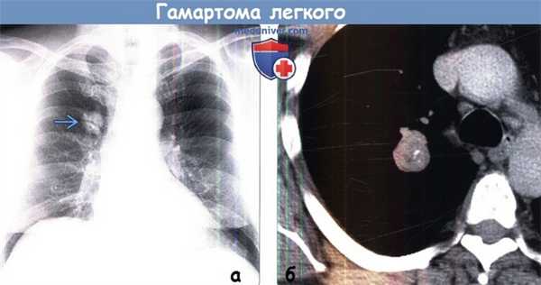 Гамартома легкого на рентгенограмме и КТ