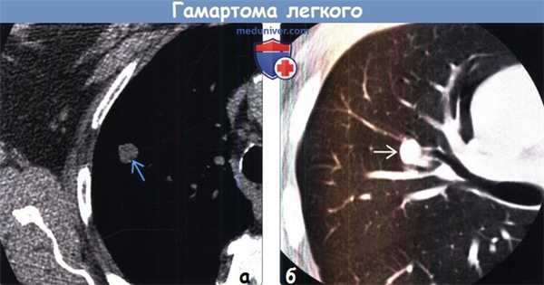 Гамартома легкого на рентгенограмме и КТ