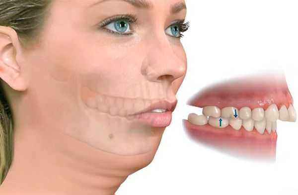 Дистальный прикус: скошенный подбородок со складками