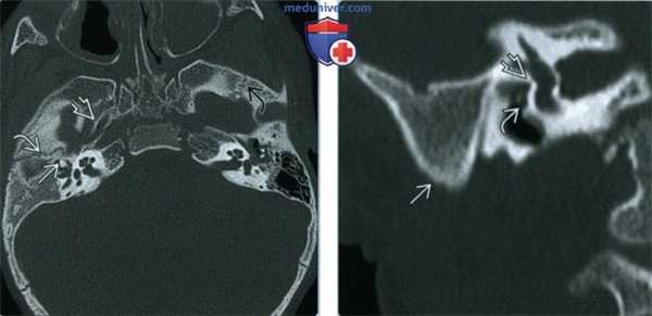 КТ, МРТ при гемифациальной микросомии