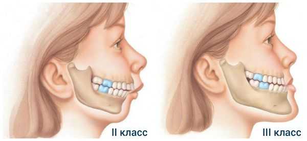 Классы дисгнатии