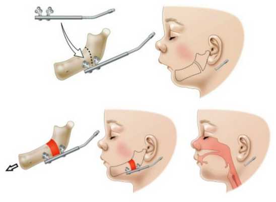 Дистракционный остеогенез нижней челюсти