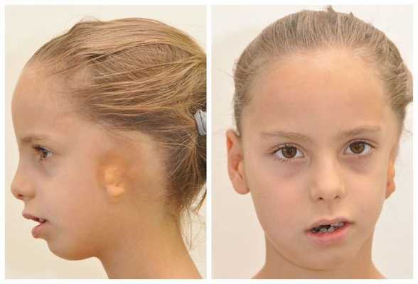 Гемифациальная микросомия