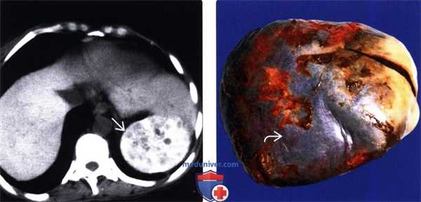 УЗИ, КТ при инфаркте селезенки
