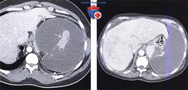 Рентгенограмма, КТ, МРТ, УЗИ при инфаркте селезенки