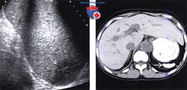 Рентгенограмма, КТ, МРТ, УЗИ при инфаркте селезенки