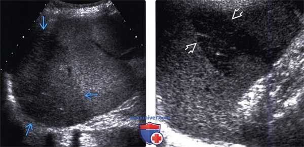 УЗИ, КТ при инфаркте селезенки