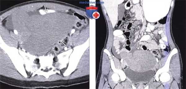 Рентгенограмма, КТ, МРТ, УЗИ при инфаркте селезенки