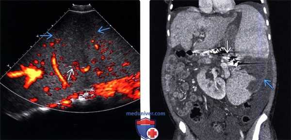 УЗИ, КТ при инфаркте селезенки