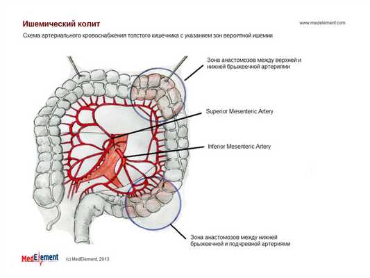 Ишемический колит