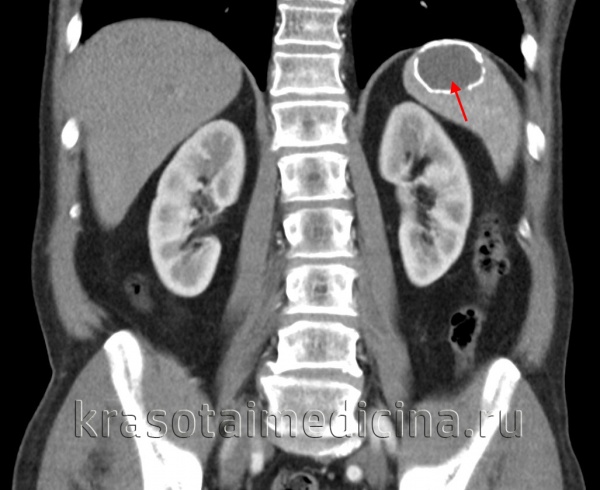 КТ ОБП. Кистозное образование в селезенке с хорошо различимой обызвествленной капсулой.