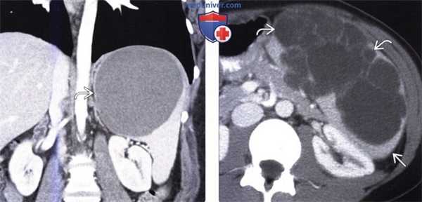КТ при кисте селезенки