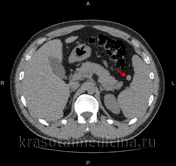 Опухоли селезенки
