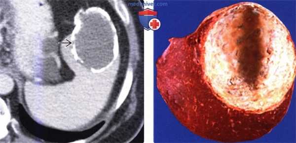 КТ при кисте селезенки