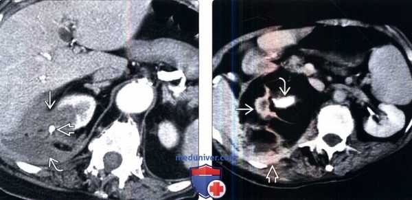 КТ при ксантогранулематозном пиелонефрите