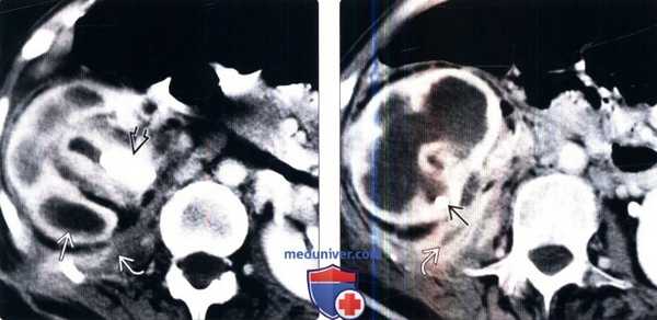 КТ при ксантогранулематозном пиелонефрите