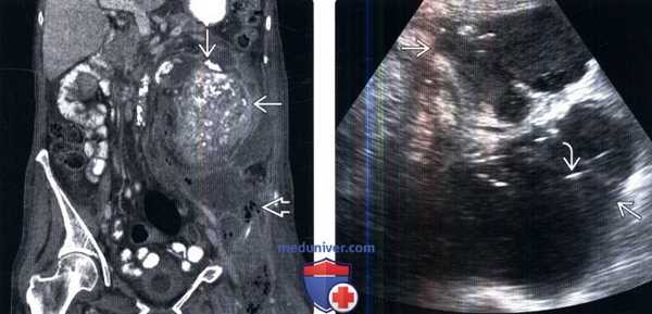 КТ, УЗИ при ксантогранулематозном пиелонефрите