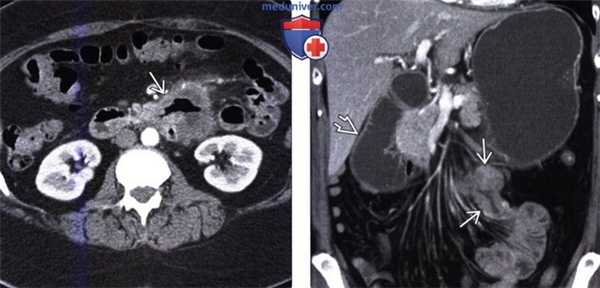 Лучевая диагностика рака тонкой кишки