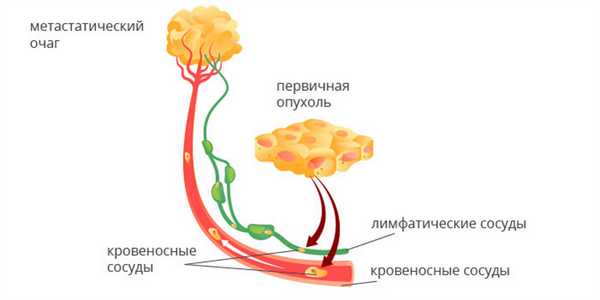 Гематогенный и лимфогенный пути распространения метастазов