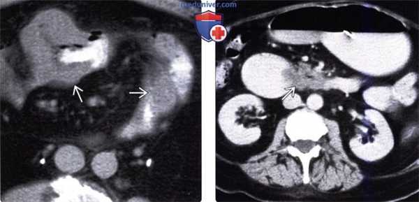 Рентгенограмма, КТ при метастазе в стенку тонкой кишки и лимфоме тонкой кишки