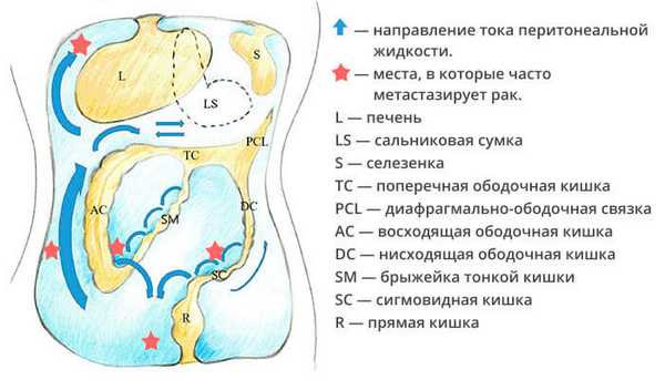 Распространение метастазов в брюшной полости