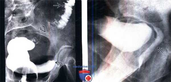 Ирригография, цистография при мочеполовом свище