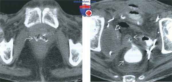 Рентгенограмма, КТ, МРТ, УЗИ при вагинальном свище