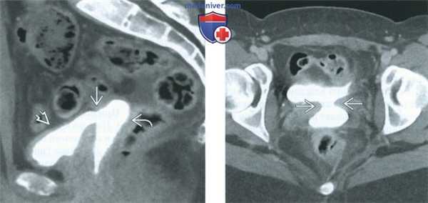 Рентгенограмма, КТ, МРТ, УЗИ при вагинальном свище