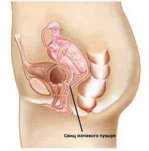 свищ мочевого пузыря