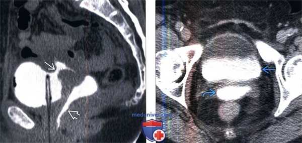 КТ при мочеполовом свище