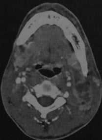 Снимки МРТ и КТ. Абсцесс шеи, флегмона