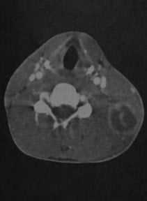 Снимки МРТ и КТ. Абсцесс шеи, флегмона