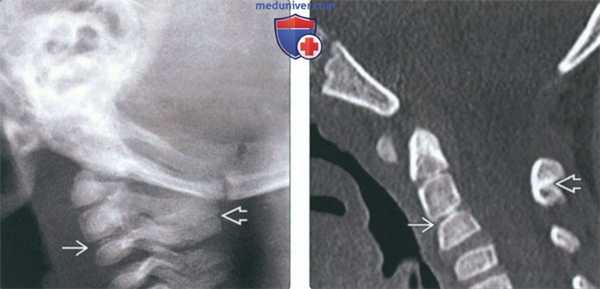 КТ при нарушении сегментации шейного отдела позвоночника