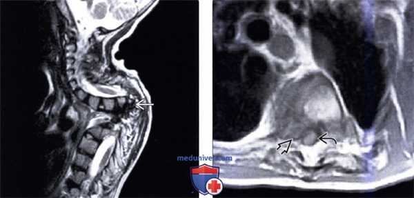 КТ, МРТ нарушения формирования позвонков