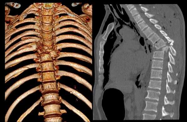 Перелом грудного отдела