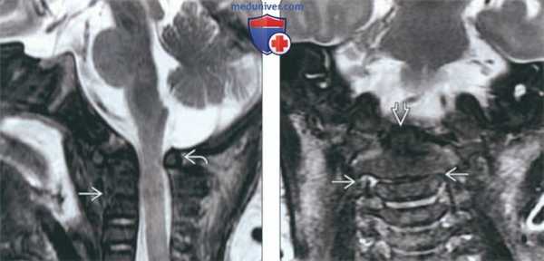 КТ при нарушении сегментации шейного отдела позвоночника