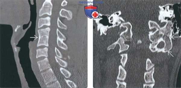 КТ при нарушении сегментации шейного отдела позвоночника