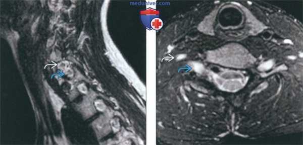 Рентгенограмма, КТ, МРТ при нарушении формирования шейного отдела позвоночника