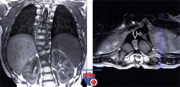 КТ, МРТ нарушения формирования позвонков