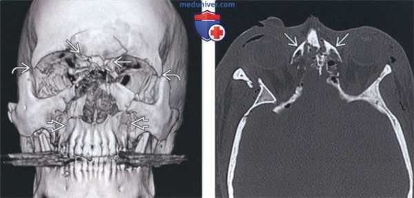 Лучевая диагностика перелома назоэтмоидального комплекса